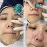醫(yī)用冷敷貼面膜械字號醫(yī)美術后消炎美白補水曬后修復收縮毛孔祛痘淡化痘印生長因子重組三型人源膠原蛋白敷料 曬單實拍圖