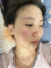 維特絲壬二酸祛痘藥膏煙酰胺凝膠去痘痘粉刺閉口男女水楊酸收毛孔青少年 曬單實(shí)拍圖