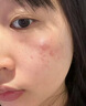 維特絲壬二酸祛痘藥膏煙酰胺凝膠去痘痘粉刺閉口男女水楊酸收毛孔青少年 曬單實(shí)拍圖