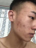 YYTISS祛痘淡化痘印去痘痘和痘印黑色素沉淀痘坑修疤復(fù)青春痘祛痘膏學(xué)生 曬單實(shí)拍圖