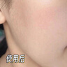 OHBT祛痘藥膏60g水楊酸祛痘淡化痘印痘坑凝膠青春痘學(xué)生青少年護膚品 曬單實(shí)拍圖