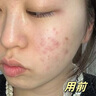 OHBT祛痘藥膏60g水楊酸祛痘淡化痘印痘坑凝膠青春痘學(xué)生青少年護膚品 曬單實(shí)拍圖