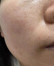醫用精華液械字號收縮毛孔粗大修復細致去黑頭粉刺閉口男士女士祛痘印黑色素沉淀控油淡化痘印痘坑透明質(zhì)酸鈉 曬單實(shí)拍圖
