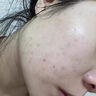 維特絲壬二酸祛痘藥膏煙酰胺凝膠去痘痘粉刺閉口男女水楊酸收毛孔青少年 曬單實(shí)拍圖