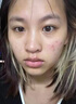 維特絲壬二酸祛痘藥膏煙酰胺凝膠去痘痘粉刺閉口男女水楊酸收毛孔青少年 曬單實拍圖