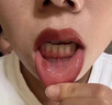 維邦樂(lè )醫用口腔含漱液漱口水消炎殺菌去口臭幽門(mén)螺旋桿菌口腔潰瘍結石牙齦腫痛止出血護齦牙周炎200ml/支*3盒 曬單實(shí)拍圖