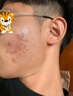 維a酸乳膏 祛痘藥膏祛痘消炎痤瘡專用青春痘祛痘膏臉上額頭長痘痘的藥淋巴痘腮邊痘粉刺祛痘印醫(yī)用皮膚用藥 1盒【精準(zhǔn)祛痘 當(dāng)天看效】 曬單實拍圖