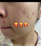 理膚泉【孫穎莎推薦】三酸煥膚精華套組30ml*2水楊酸褪油痘淡紅印護膚品 曬單實拍圖