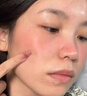 維特絲壬二酸祛痘藥膏煙酰胺凝膠去痘痘粉刺閉口男女水楊酸收毛孔青少年 曬單實(shí)拍圖