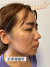 南京同仁堂祛痘膏去痘痘和痘印痘坑修復(fù)男女士改善粉刺閉口30g 曬單實(shí)拍圖