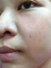 醫(yī)用精華液械字號(hào)收縮毛孔粗大修復(fù)細(xì)致去黑頭粉刺閉口男士女士祛痘印黑色素沉淀控油淡化痘印痘坑透明質(zhì)酸鈉 曬單實(shí)拍圖