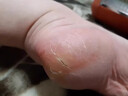 CNDK足部真菌王腳氣腳癢水泡脫皮腳臭香港腳腳汗?fàn)€腳丫真菌感染止癢膏 今日活動【強效款-2盒療城裝】 曬單實拍圖