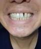 補(bǔ)牙洞齒神器材料自己在家補(bǔ)牙樹脂補(bǔ)牙齒修復(fù)凝膠醫(yī)用高硬度 1盒體驗(yàn)裝【能補(bǔ)10顆】 曬單實(shí)拍圖
