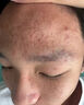 YYTISS祛痘藥膏淡化痘印消除坑炎痤瘡專(zhuān)用青少年去痘痘和痘印青春痘學(xué)生 曬單實(shí)拍圖