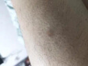 CNDK去脖子肉揪頸部臉部手足腋下云南本草絲狀猴植物草本精華男女外用 今日活動(dòng)【強效款-2盒療程裝】 曬單實(shí)拍圖
