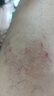 藤田制藥濕疹藥膏止癢去根皮膚瘙癢皮炎濕疹真菌感染汗皰疹肛門瘙癢1盒 曬單實(shí)拍圖