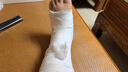 適夫安骨折洗澡防水套石膏保護套術(shù)后防水腳套洗澡神器手臂腿部腳踝防水 防水沐浴套-成人大腿部（中號） 曬單實(shí)拍圖