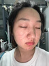 維特絲壬二酸祛痘膏煙酰胺凝膠去痘痘粉刺閉口男女水楊酸收縮毛孔青少年 曬單實拍圖