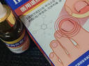 Newliann醫用甲溝炎消腫專(zhuān)用工具息肉紅腫去肉芽嵌甲發(fā)炎化膿膏矯正器制藥 曬單實(shí)拍圖