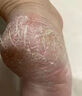 角化型腳氣頑固性腳后跟真菌感染干裂脫皮專(zhuān)用藥腳起硬皮足跟開(kāi)裂脫皮去真菌皮膚干裂腳趾縫潰爛爛腳丫華佗膏 1盒【腳干燥開(kāi)裂脫皮】推薦多盒劃算 曬單實(shí)拍圖