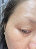 同仁堂脂肪粒去除神器眼部專用去眼部脂肪粒消汗管瘤眼袋清肌顆粒教師節(jié) 曬單實(shí)拍圖