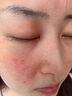 焦博士日本曬后修復(fù)面膜修復(fù)敏感皮膚屏障受損泛紅醫(yī)美用防曬傷急救白 曬單實拍圖