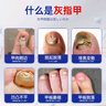 光島制薬灰指甲專(zhuān)用特指甲真菌感染重度灰指甲脫甲壞甲抑菌液3盒 曬單實(shí)拍圖