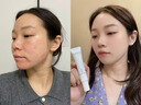 SKISGEM祛痘膏30g淡化痘印消除痘坑修復凝膠青春痘德國進(jìn)口教師節禮物 曬單實(shí)拍圖