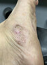 傾姿堂腳氣噴劑止癢脫皮爛腳丫真菌感染去水泡型腳汗腳臭專用噴霧35ML 曬單實拍圖