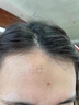 沃朗森醫(yī)用祛疤膏祛疤痕修復(fù)凝膠醫(yī)院專用去疤痕藥膏硅酮除疤膏手術(shù)縫針 曬單實(shí)拍圖
