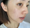 克林霉素甲硝唑搽劑祛痘消炎治痤瘡去青春痘粉刺硬疙瘩膿包修復(fù)痘印青少年皮膚專用藥可搭配藥膏【視覺特效】 2盒【建議療程裝】 曬單實(shí)拍圖