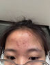 維特絲壬二酸祛痘藥膏煙酰胺凝膠去痘痘粉刺閉口男女水楊酸收毛孔青少年 曬單實(shí)拍圖