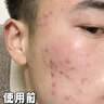 Newliann醫用械字號洗面奶狀潔面乳控油祛痘除螨蟲(chóng)去黑頭男士女士修復屏障 曬單實(shí)拍圖