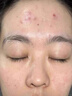 OHBT祛痘膏60g青春痘閉孔粉刺收縮毛孔專用學(xué)生男女凝膠男士化妝品 曬單實(shí)拍圖
