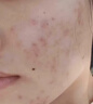 安伊妮青少年凈痘精華乳女控油修護舒緩保濕祛痘膏快速消紅腫痘印小白管 曬單實(shí)拍圖