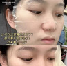 醫(yī)用冷敷貼面膜型械字號(hào)透明質(zhì)酸鈉修復(fù)貼敷料醫(yī)美術(shù)后消炎去紅美白補(bǔ)水曬后修復(fù)收縮毛孔祛痘控油淡化痘印 曬單實(shí)拍圖