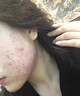 YYTISS祛痘藥膏淡化痘印消除坑炎痤瘡專用青少年去痘痘和痘印青春痘學(xué)生 曬單實(shí)拍圖