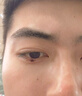 蘇泉（Suquan）點(diǎn)痣激光筆點(diǎn)痣筆去痣點(diǎn)痦子洗紋身扁平痣疣美容院家用小白祛痣筆 曬單實(shí)拍圖