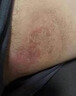 秋雅奈緒股癬專(zhuān)擁用藥膏股癬膏大腿內側真菌感染腹股溝股癬陰囊瘙癢止癢膏 一盒裝【體驗裝】 曬單實(shí)拍圖