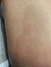 股蘚大腿內側真菌感染腹股溝股癬膏大腿根內測潮濕瘙癢癬藥水噴霧專(zhuān)用藥真菌感染皮膚用藥鹽酸特比萘芬噴霧劑 3盒【股癬反復長(cháng)】【視覺(jué)特效】 曬單實(shí)拍圖