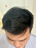 沃朗森醫用毛囊炎洗發(fā)水脂溢性皮炎去屑止癢頭部皮專(zhuān)用控油疙瘩藥監認證 曬單實(shí)拍圖