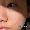維特絲壬二酸祛痘藥膏煙酰胺凝膠去痘痘粉刺閉口男女水楊酸收毛孔青少年 曬單實(shí)拍圖