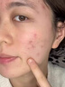 華美科面膜祛痘控油祛痘毛孔收縮祛痘面膜淡化女痘印收縮毛孔面膜印1盒 曬單實(shí)拍圖