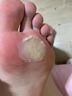老繭軟化膏繭子去除器腳底厚繭死皮腳趾關(guān)節繭軟化劑腳后跟硬皮 買(mǎi)3送2【鞏固裝】500%包掉繭 去腳底老繭去硬皮去老繭神器進(jìn)口 曬單實(shí)拍圖