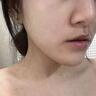 醫(yī)用精華液械字號(hào)收縮毛孔粗大修復(fù)細(xì)致去黑頭粉刺閉口男士女士祛痘印黑色素沉淀控油淡化痘印痘坑透明質(zhì)酸鈉 曬單實(shí)拍圖