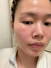 Newliann醫用械字號面膜冷敷貼醫美術(shù)后修復保濕補水激光修護祛痘痤瘡皮炎 曬單實(shí)拍圖