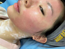沃朗森醫(yī)用面膜械字號(hào)冷敷貼醫(yī)美術(shù)后補(bǔ)水修復(fù)敷料祛痘印消炎透明質(zhì)酸鈉 曬單實(shí)拍圖