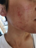 儒意水楊酸祛痘精華痘印修復(fù)淡化痘印控油收縮毛孔去黑色素沉淀護(hù)膚品 40ml 【1滴祛痘】輕度痘肌 紅腫膿痘 曬單實(shí)拍圖