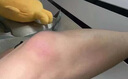 皮脂腺囊腫專用藥膏拔毒藥膏火癤子膿包疙瘩皮脂腺囊腫脂肪瘤專用特硬塊效藥皮膚用藥 非處方藥莫匹羅星軟膏 1盒【皮脂腺囊腫專用藥膏】早用早好 曬單實拍圖