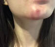 皮脂腺囊腫消除特用有效藥痤瘡硬疙瘩專用藥紅腫硬塊痘痘消炎拔毒藥膏火癤子膿包疙瘩皮脂腺囊腫莫匹羅星軟膏 1盒【皮脂腺囊腫醫(yī)用藥膏】 曬單實拍圖